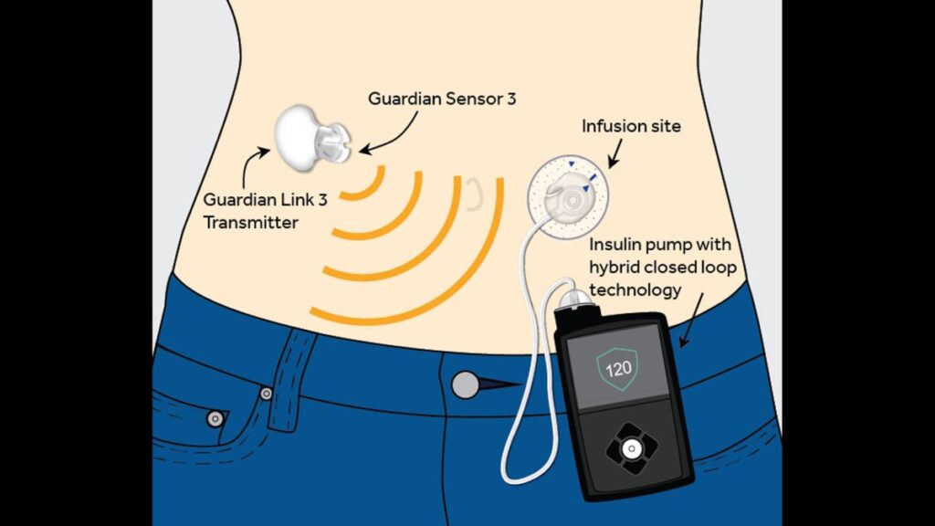 How Can an 'Artificial Pancreas' Benefit People with Type 1 Diabetes?