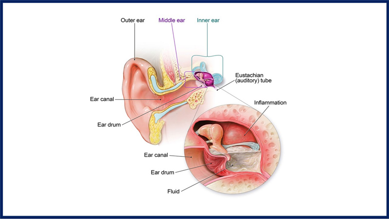 How to accurately diagnose acute otitis media in children?