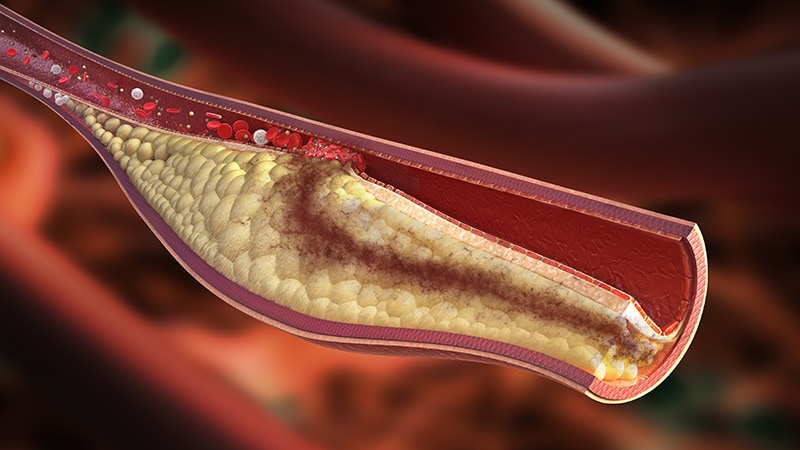 The Impact of Preventive Percutaneous Coronary Intervention (PCI) on Non-Flow-Limiting Vulnerable Plaques