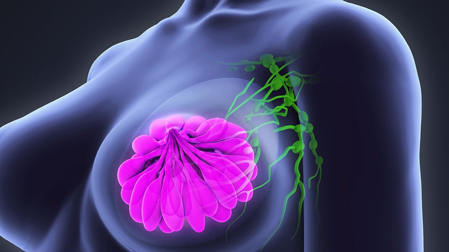 What is Sentinel-Node Macrometastases? Understanding the Impact on Breast Cancer Treatment