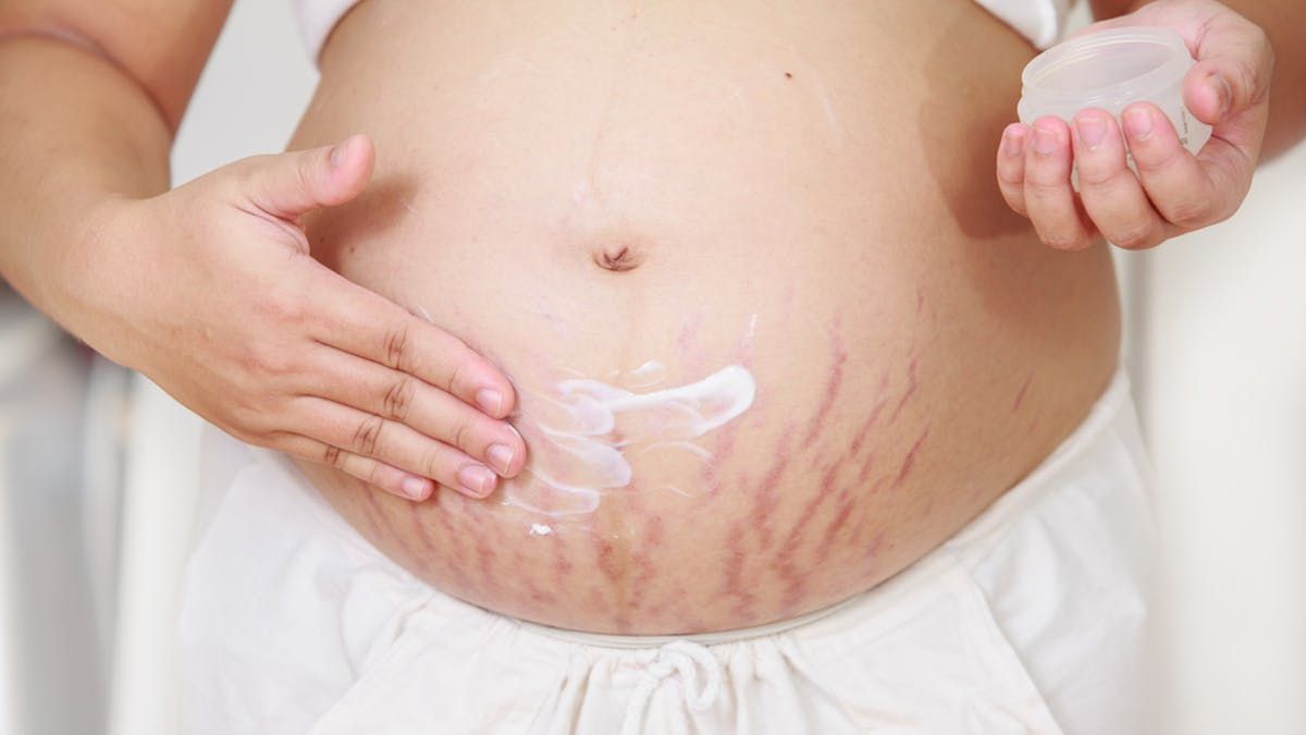 How Are Stretch Marks Treated Globally and What Factors Influence the Market Growth?