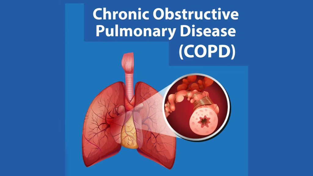 How Can Undiagnosed Asthma or COPD Patients Benefit from Early Detection and Treatment?