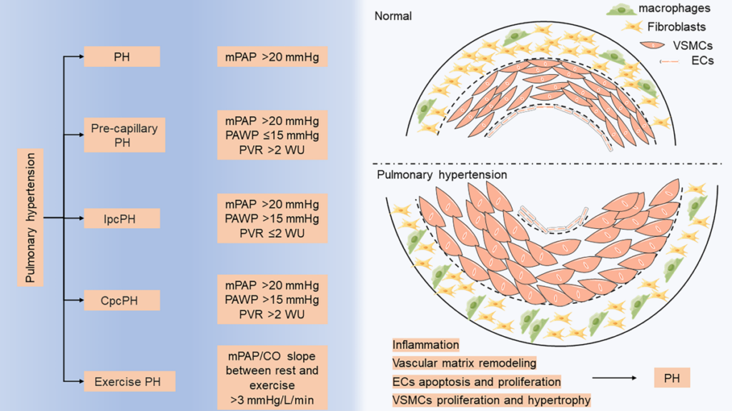 How Does Hormone Replacement Therapy Impact Pulmonary Arterial Pressure and Right Ventricular Function in Women with Pulmonary Hypertension?