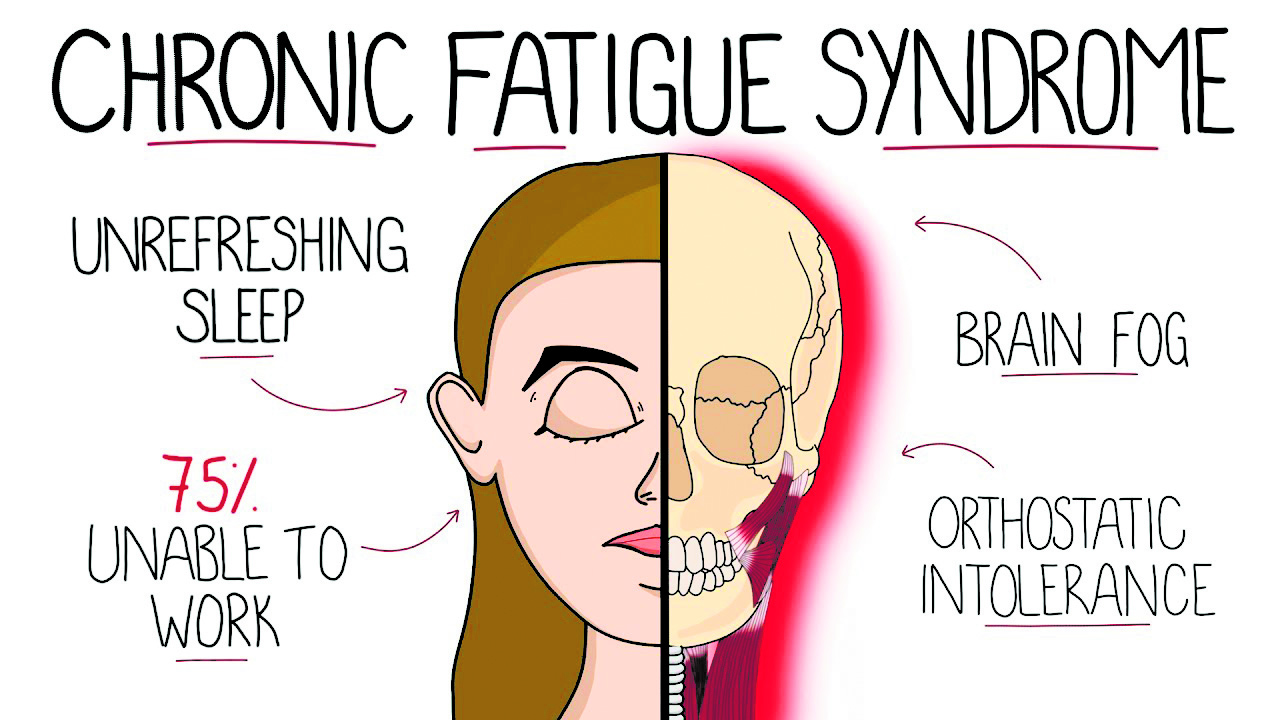 How can individuals manage Chronic Fatigue Syndrome effectively?