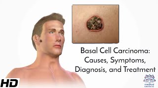 What are signs of a basal cell carcinoma under the eye and how can it be detected early?